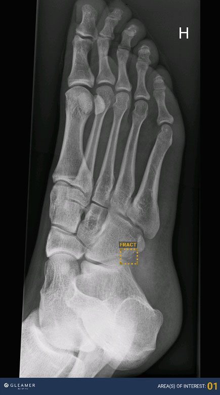 Bilde av den første foten som er analysert ved hjelp av kunstig intelligens.