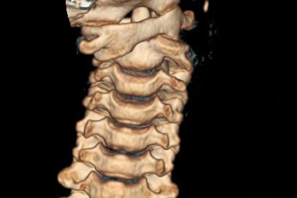 3D CT bilde av atlanto-axial rotasjonssubluksasjon.png