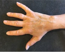 Håndartrose - øvelse 6.png