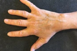 Håndartrose - øvelse 6.png