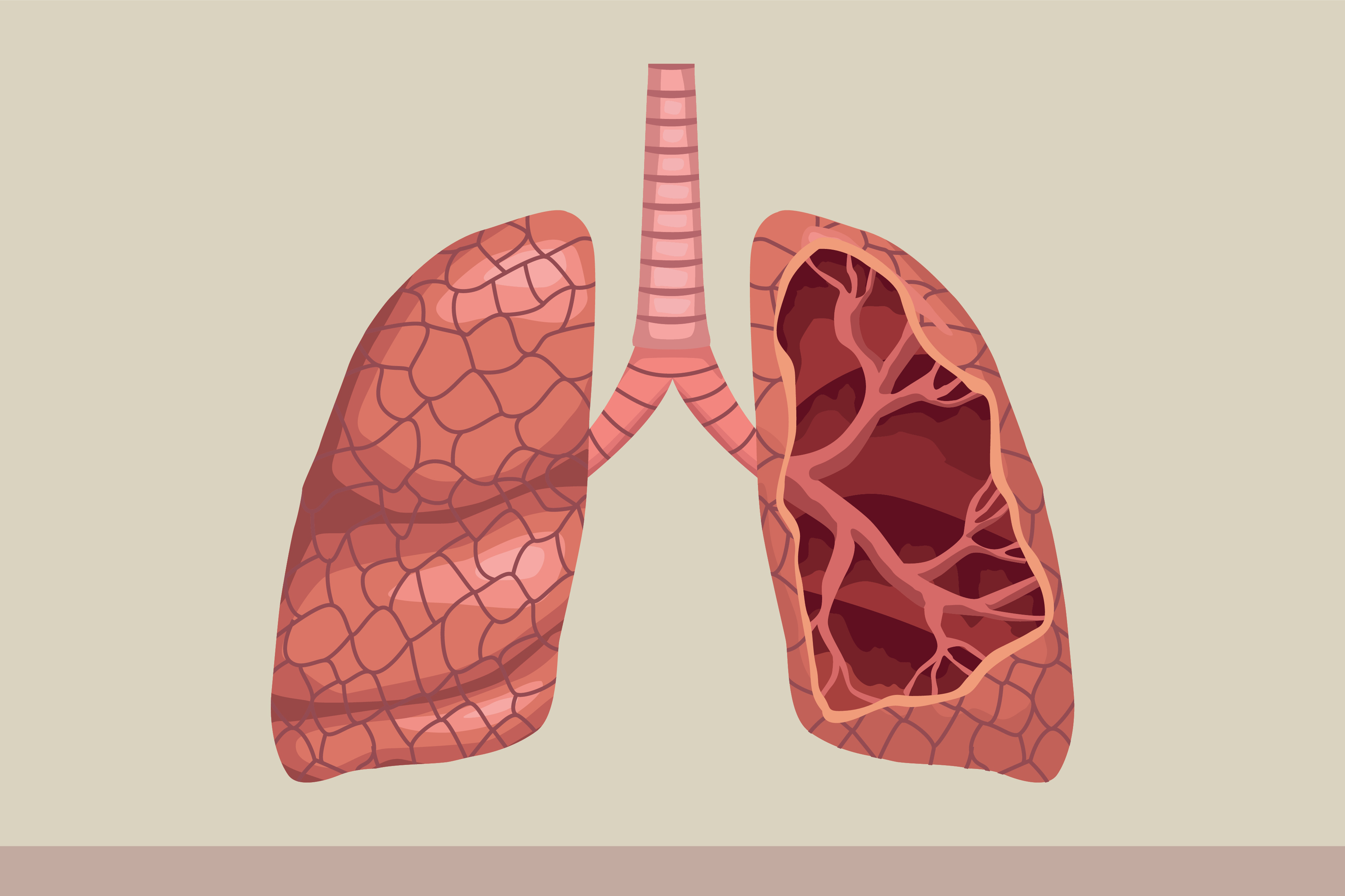 illustrasjon av syke lunger