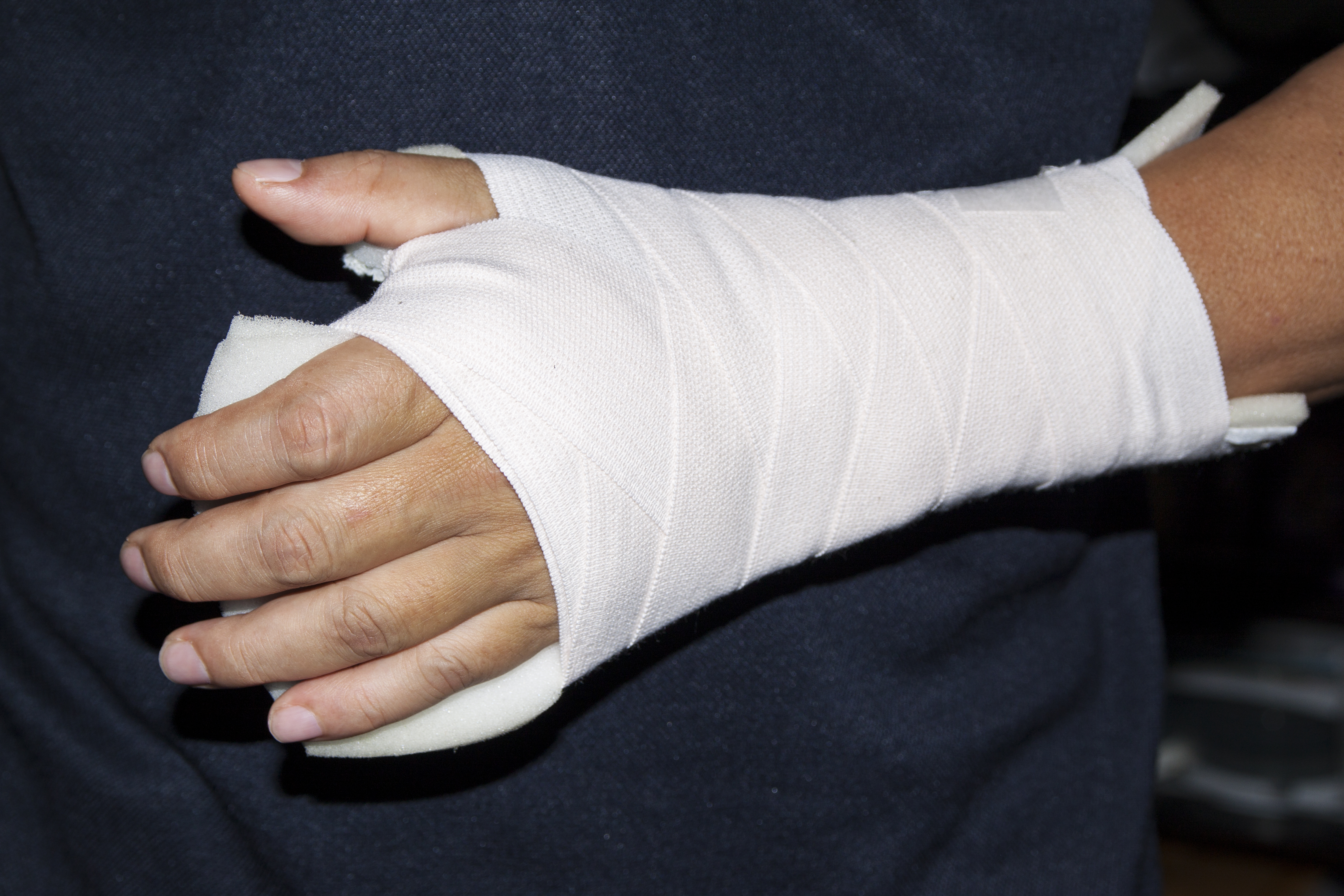 en hånd som er gipset etter håndleddsbrudd
