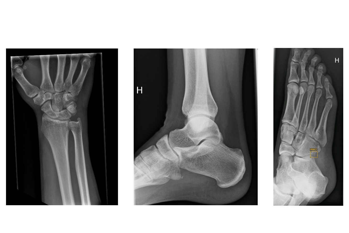 Tre røntgenbilder: håndledd, ankel og fot sett fra ulike vinkler.