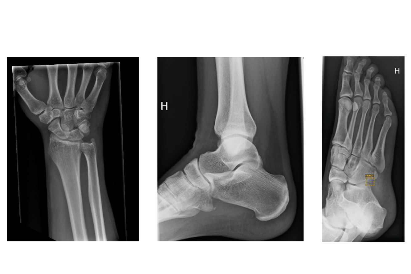 Tre røntgenbilder: håndledd, ankel og fot sett fra ulike vinkler.